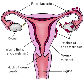 Endometriosis anatomy diagram