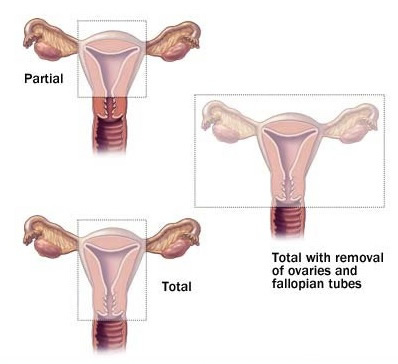 Hysterectomy diagram