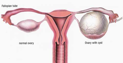 Ovary with Cyst